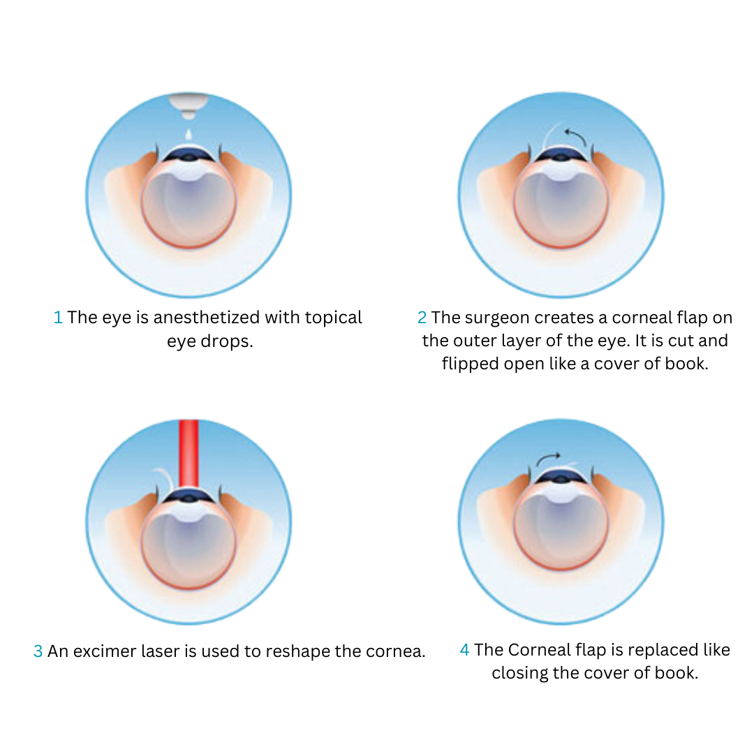 Refractive Surgery Symptoms