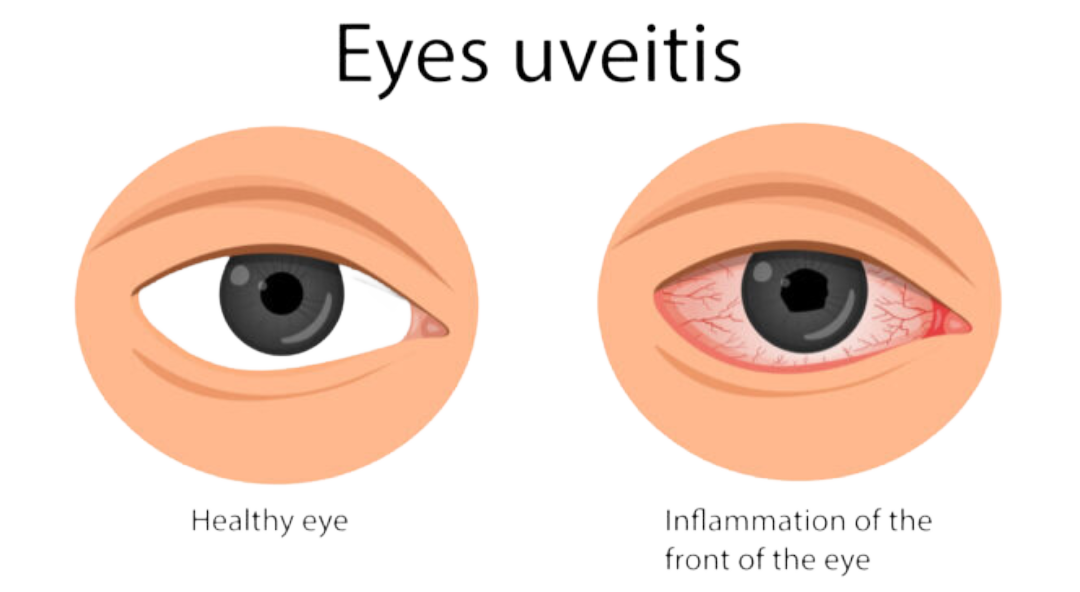 Vitreo Retinal Uveitis Services Symptoms