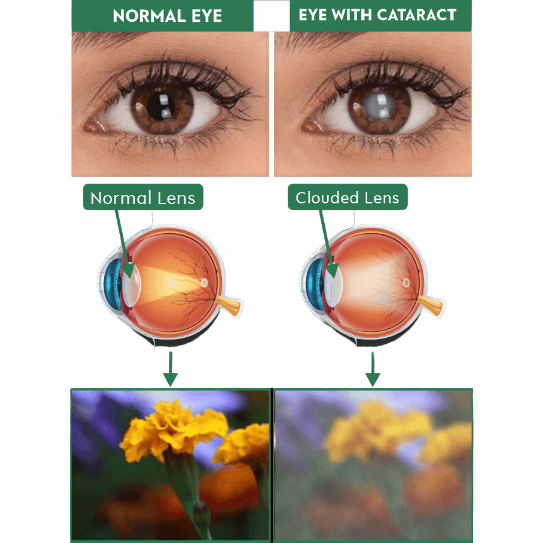 Cataract Symptoms